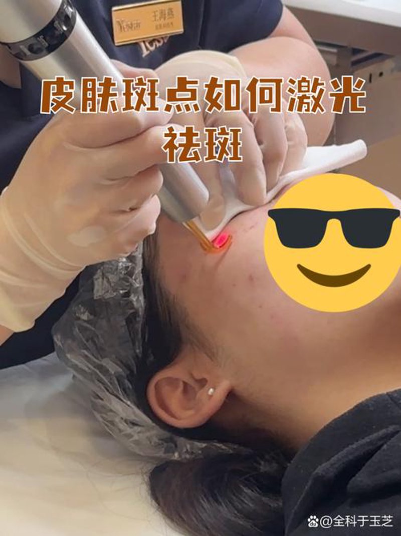 激光祛斑