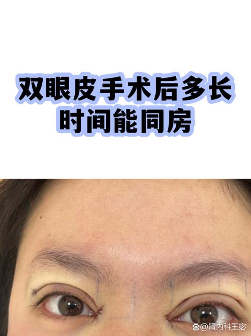 双眼皮手术的新风尚