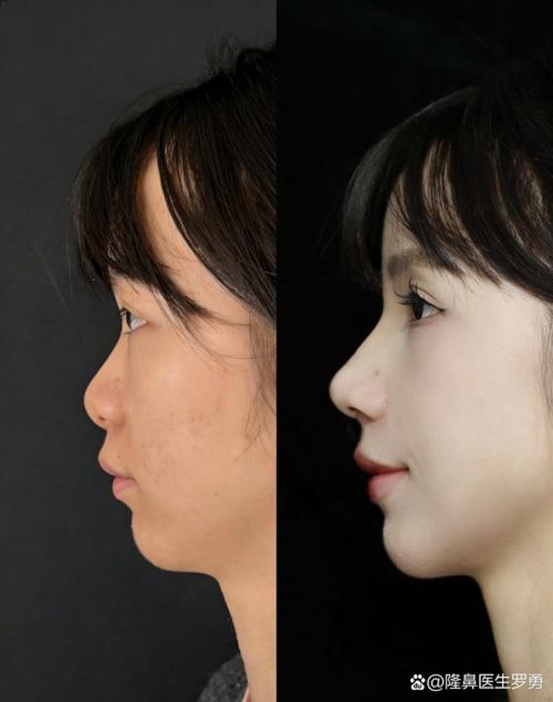 隆鼻整形