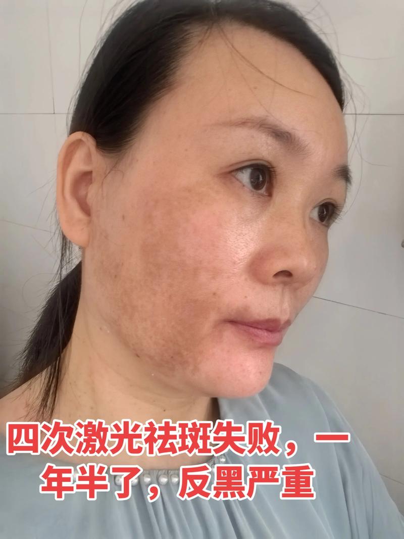 轻松拥有迷人鼻梁——全面解读隆鼻整形选购指南